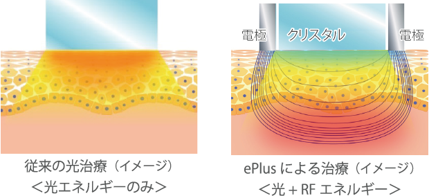 ePlus RF による深部の加熱