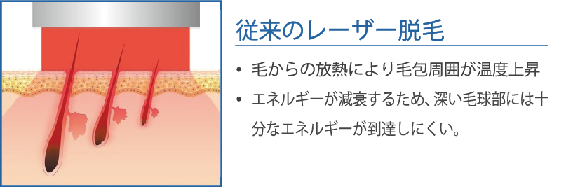 Motif LHR アプリケータのアプローチ
