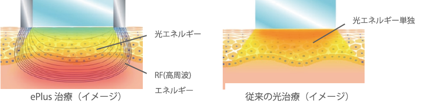 色調改善だけではない SR アプリケータのアプローチ